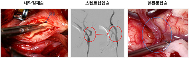 [사진] 1. 내막절제술 / 2. 스텐트삽입술 / 3. 혈관문합술
